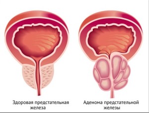 Доброкачественная гиперплазия предстательной железы