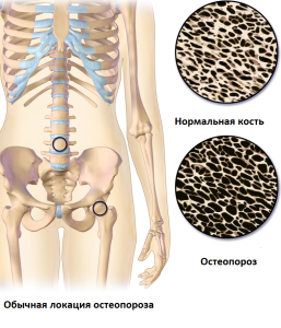 Нормальная и пораженная остеопорозом кость
