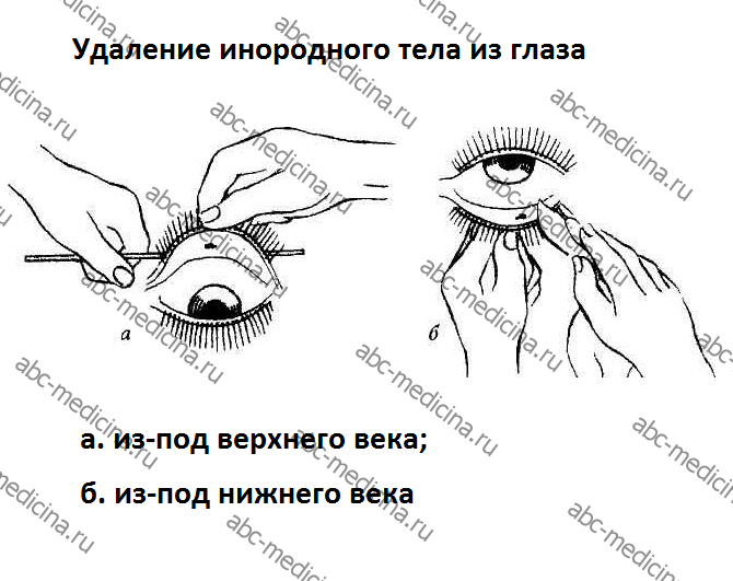 Удаление инородного тела из глаза, если оно под верхним или нижним веком