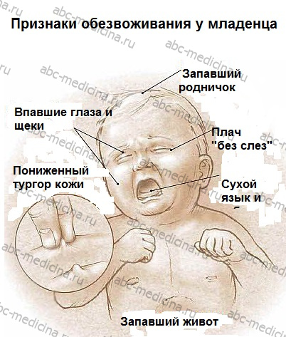 Симптомы обезвоживания у младенца