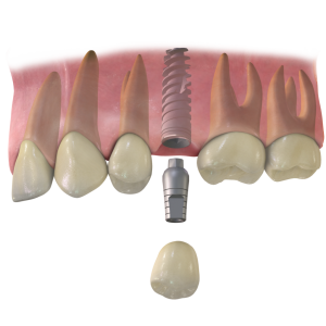 Конструкция искусственного зуба